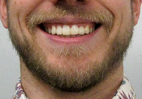 beard close up