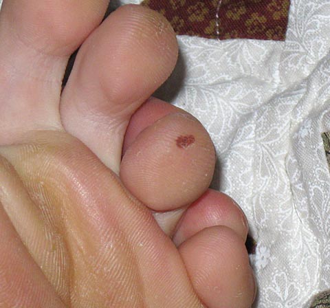 Tiny Blood Blisters